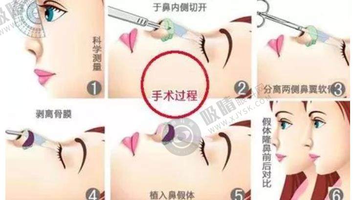 二十多年鼻整形经验医生揭秘：深圳宝丽李信锋个人简历、擅长项目、价格及患者口碑全解析