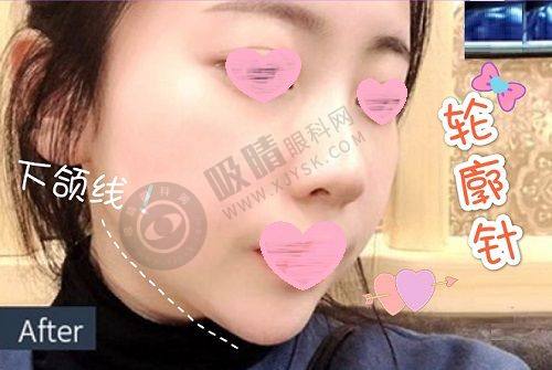 2. 杭州美莱整形有哪些特色项目？