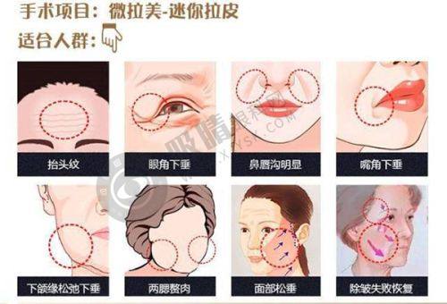 3. 温州芘丽芙整形医院的双眼皮手术有哪些方式？