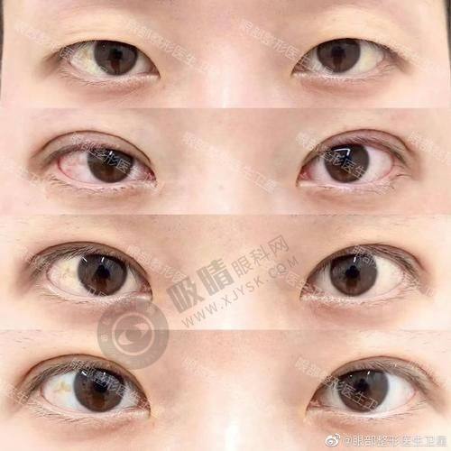 浙江义乌艺星医疗美容医院好不好？连锁品牌+韩国技术，双眼皮隆鼻效果自然又持久！