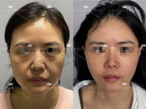 台州艺星医疗美容医院的真实实例成效如何？