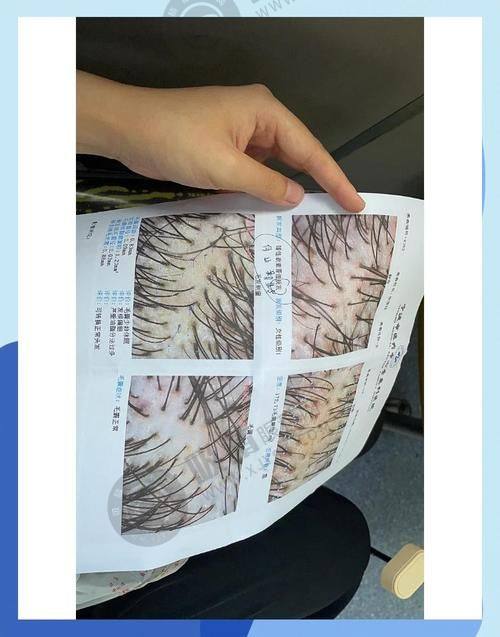 4. 金华玥莱美植发的价格如何？