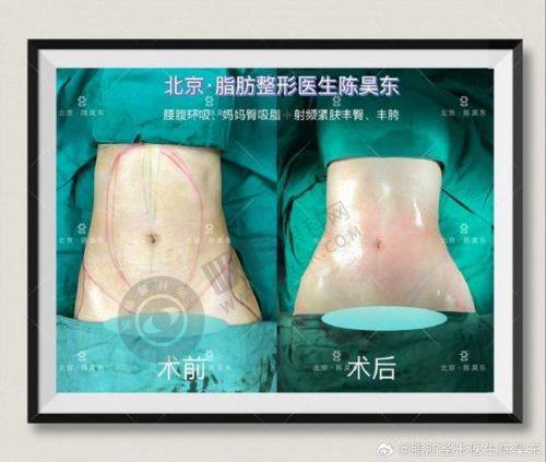 宁波熙美吸脂专科医院好不好？三度分层吸脂+瑞士技术，9000元起塑形效果惊艳！