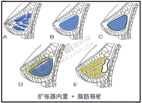4. 浙江金华显赫（原玥莱美）植发专科特色项目