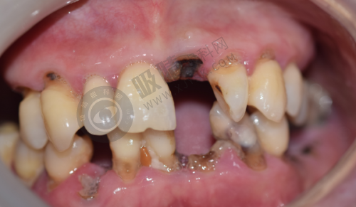 台州依笑口腔门诊部种牙怎么样？数字化导板技术+3068元优惠套餐，让您重获自信笑容！
