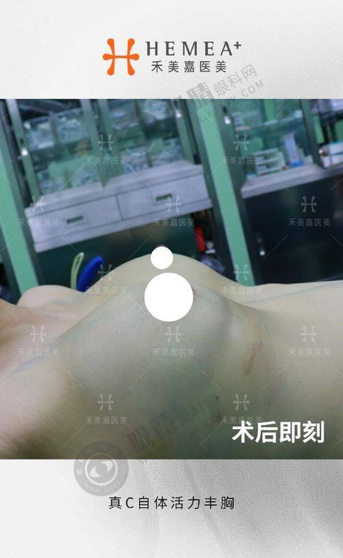 杭州奥拉克医疗美容靠谱吗？韩系技术+进口设备，吸脂塑形1万起效果惊艳！