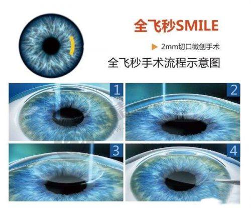 四、郑州视光眼科华厦医院还有哪些眼科项目及价格？