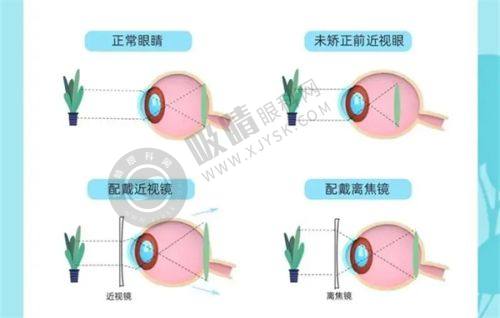 二、全飞秒激光手术有哪些优势？
