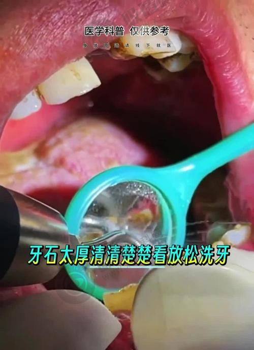 5. 去汕头牙加美口腔医院种牙方便吗？
