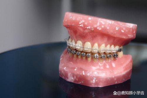 2. 衢州牙微笑柯城口腔的价格优势如何？