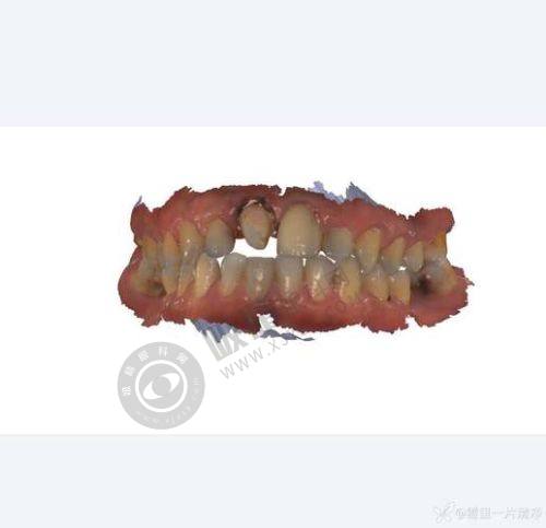 3. 杭州盈盈口腔的种植体有哪些？价格如何？