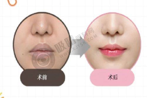 郑州韩辰华领整形医院正规吗？设备先进+医生专业，伊妍仕少女针授权医院效果自然！