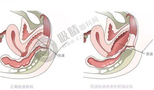 正确选择大分子玻尿酸