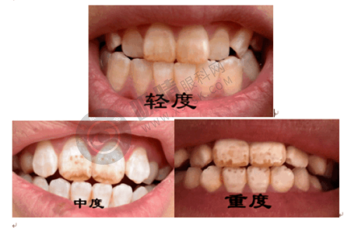 5. 郑州植得口腔医院的种植牙价格贵吗?