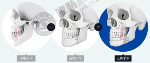 玻尿酸塑形下巴：微创打造精致V脸！