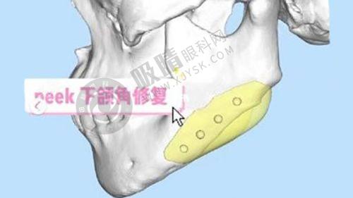 3. 郑州米兰柏羽集美医疗美容眼鼻整形成效如何？