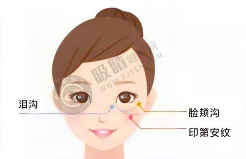 后悔大分子玻尿酸注射垫下巴的原因