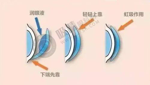 2025广西视光中 心青少年近视防控(角膜塑形镜)价格