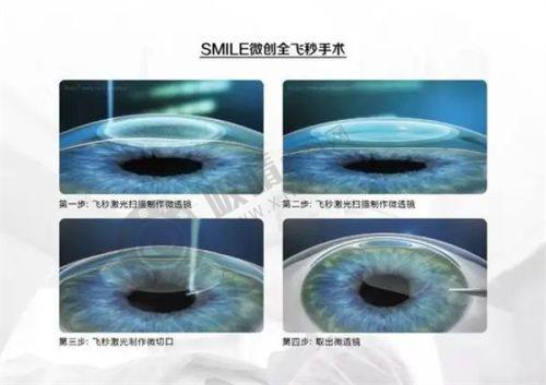 2025太原爱尔眼科近视手术降价！全飞秒1.7万起，ICL2.8万起，省钱攻略大公开