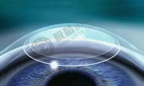 南昌大学第二附属医院近视手术价格表：激光11800元起，13种术式可选