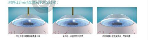 焦作尖峰眼科医院患者口碑评价
