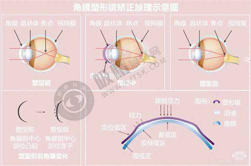 南宁爱尔眼科医院近视手术情况剖析