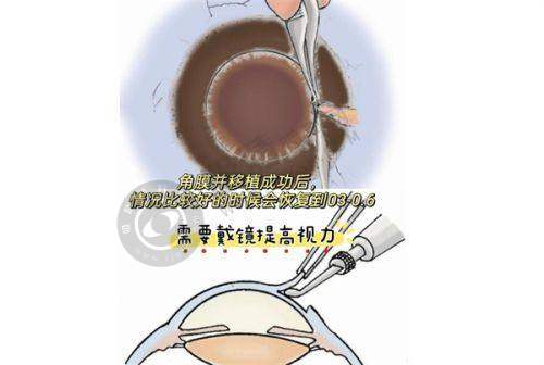 为何选择南宁爱尔眼科医院做近视眼矫正手术