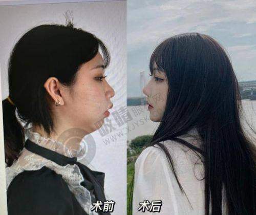 重庆唇腭裂修复医院排名TOP10！星荣/松山/华美技术大PK，术后效果惊艳
