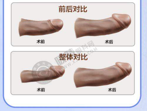 重庆大脚骨医院哪家强？骑士医院微创矫正VS松山医院5mm切口，张荣辉医生团队口碑爆棚！