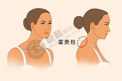 杭州艺星做双眼皮之总结