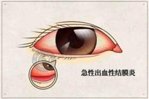 海南博鳌乐城爱尔眼科靠谱吗？专业团队+真实案例，角膜塑形镜效果惊人！