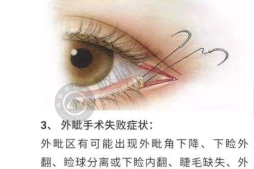 广州奥美定取出非凡医院