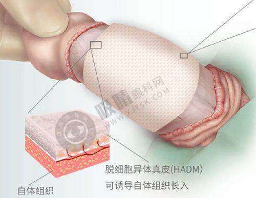 三、国内变性手术收费情况