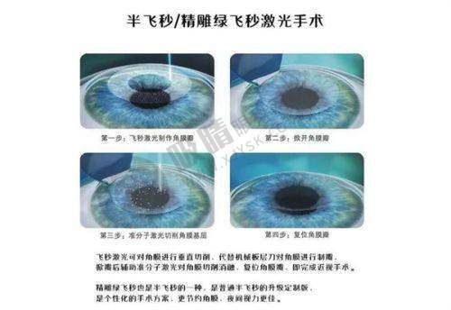 段安丽医生擅长的眼科手术价格表