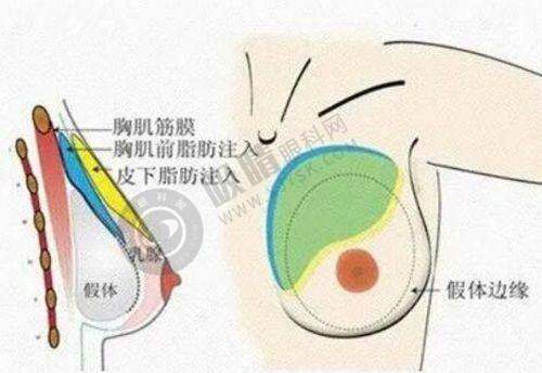 北京叶子医美正规靠谱吗？16年老牌连锁机构、四级手术资质，X形榫卯鼻综合3万起效果惊艳！
