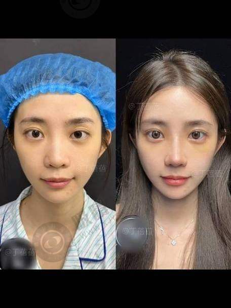 三、南昌地区双眼皮项目收费情况
