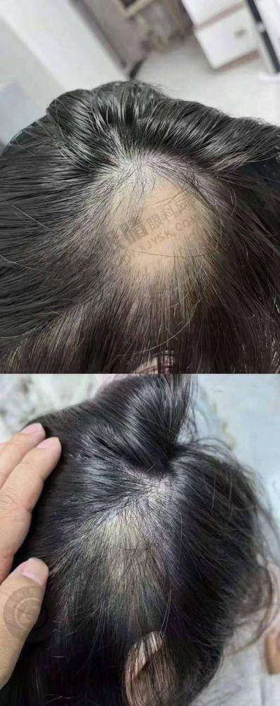三、成都植发项目收费情况