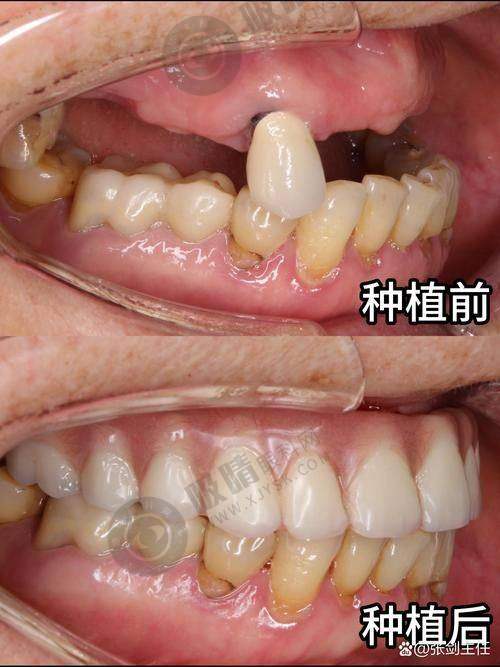 南昌拜博口腔哪位医生种牙好？叶平、谢晨、蒋泽先三大专家技术、特色详细解析