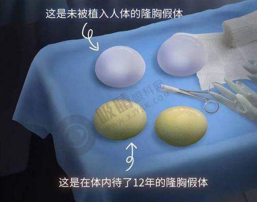 殷初阳隆胸手术效果如何？靠谱！20年经验+内窥镜技术打造自然美胸