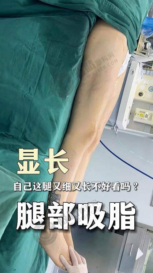西安西美医院直腿术靠谱吗？正规四级资质、威塑吸脂安心可靠打造女团腿