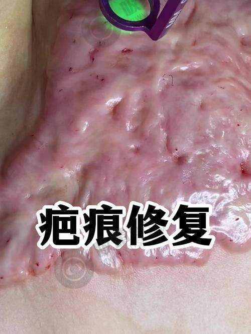 深圳鹏程医院疤痕科正规资质