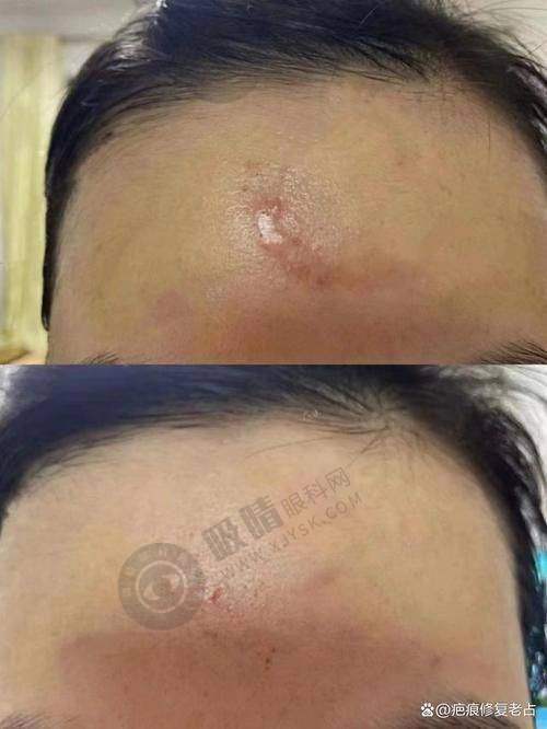 深圳鹏程医院疤痕科特色项目及技术优势