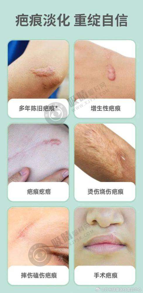 深圳鹏程医院疤痕科医生团队实力强大