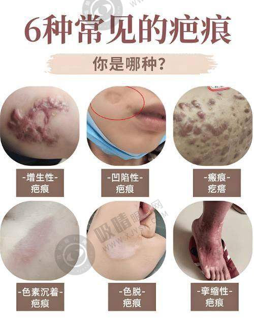 深圳鹏程医院疤痕科预约挂号方式及流程