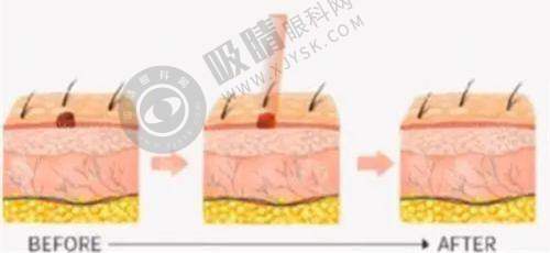 整形美容医院——吸脂技术实力强且价格实惠