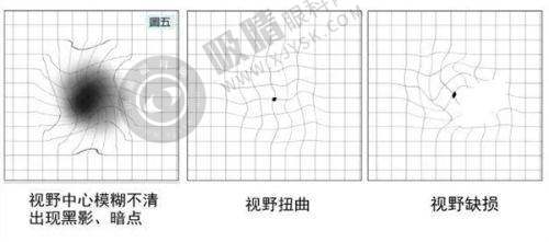 郑州普瑞眼科医院:郑州近视手术技术与服务并重