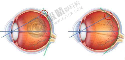 郑州人民医院眼科:郑州近视手术国有医院的可靠选择