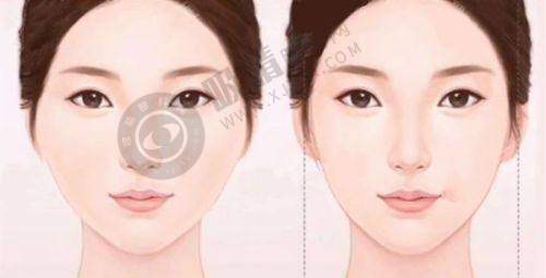 广州艺星医疗美容医院怎么样？真人案例效果惊艳，美杜莎双眼皮+6G钻石吸脂技术领先