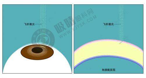 三、山东爱维视眼科医院的白内障手术口碑如何？