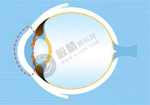 临汾洛基眼科医院白内障手术多少钱？美国眼力健晶体10600元起，医保定点可报销